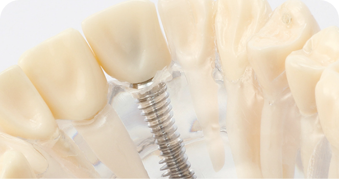 歯を失ってお困りのあなたへ