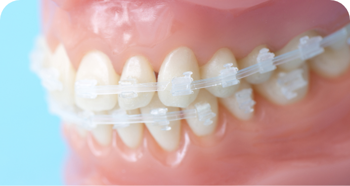 歯並びを気にしているあなたへ