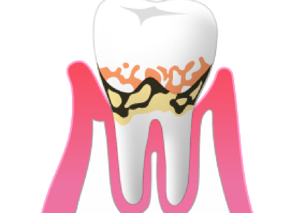 軽度の歯周炎|大和市大和駅徒歩4分の歯医者 大和東さくら歯科・矯正歯科