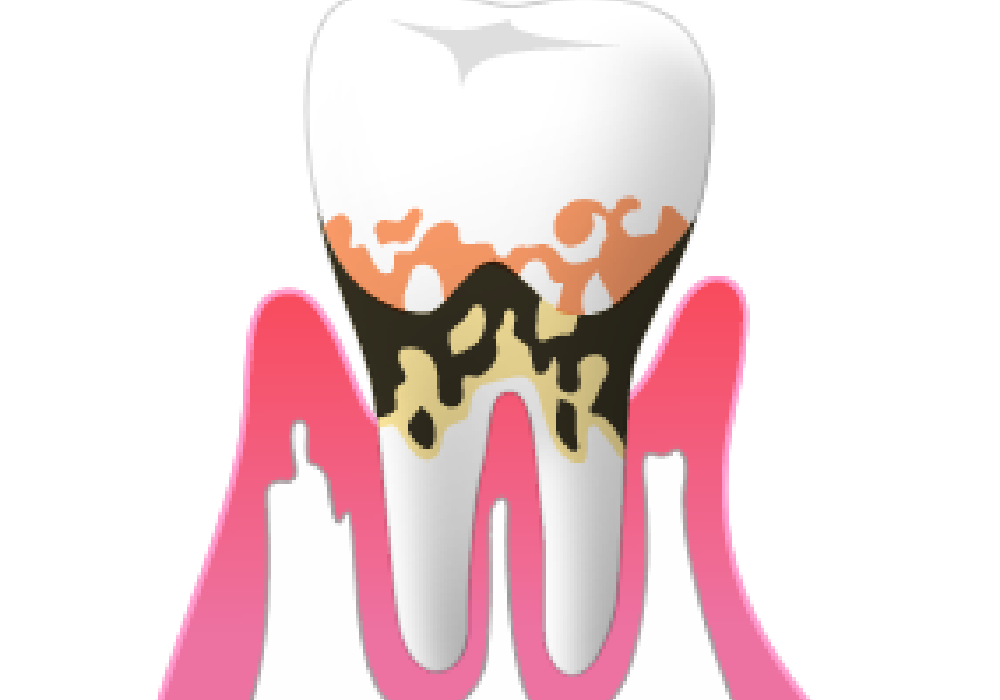 中度の歯周炎|大和市大和駅徒歩4分の歯医者 大和東さくら歯科・矯正歯科