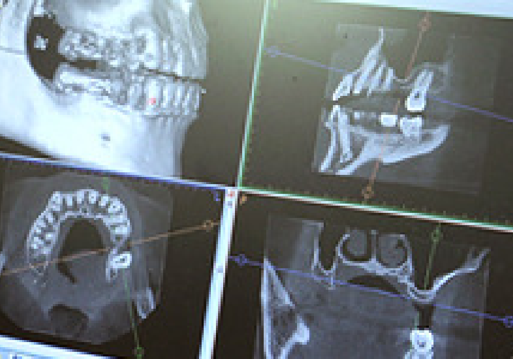 インプラント治療の、欠点、副作用|大和市大和駅徒歩4分の歯医者 大和東さくら歯科・矯正歯科