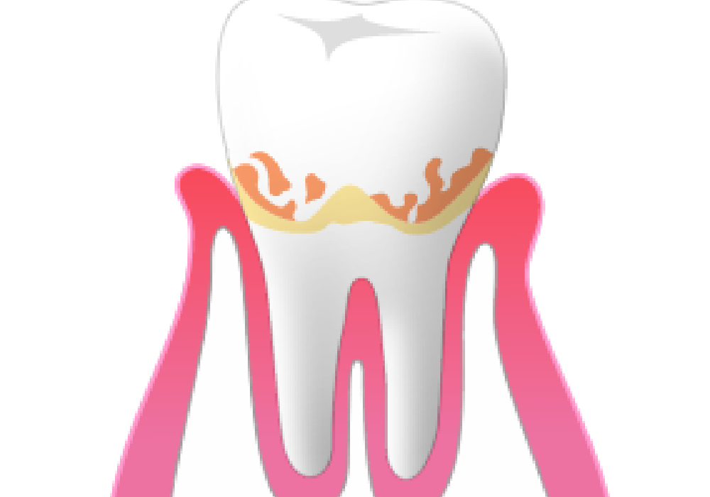 初期（歯肉炎）|大和市大和駅徒歩4分の歯医者 大和東さくら歯科・矯正歯科