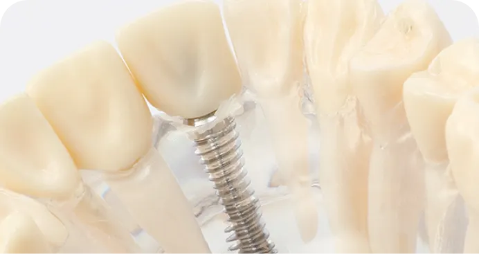 歯を失ってお困りのあなたへ